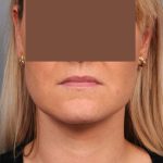 Neck Liposuction / Chin Liposuction Before & After Patient #2034