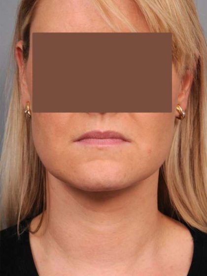 Neck Liposuction / Chin Liposuction Before & After Patient #2034