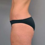 Tummy Tuck Before & After Patient #363