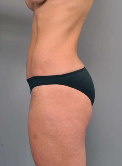 Tummy Tuck Before & After Patient #363