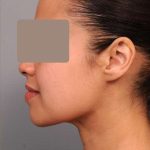 Neck Liposuction / Chin Liposuction Before & After Patient #2046