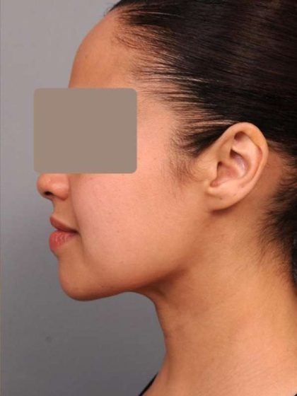 Neck Liposuction / Chin Liposuction Before & After Patient #2046