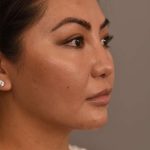 Buccal Fat Removal Before & After Patient #2063
