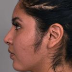 Buccal Fat Removal Before & After Patient #2099