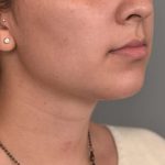 Buccal Fat Removal Before & After Patient #2127