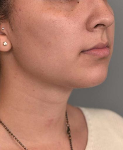 Buccal Fat Removal Before & After Patient #2127