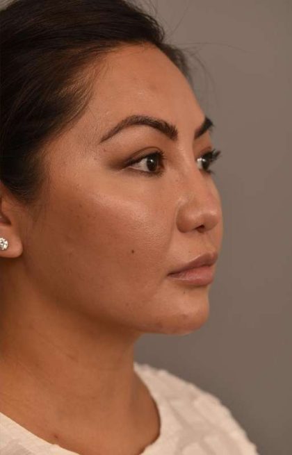 Cheek Liposuction Before & After Patient #2136