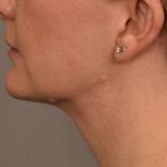 Cheek Liposuction Before & After Patient #2165