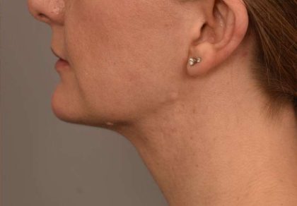 Cheek Liposuction Before & After Patient #2165