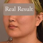 Cheek Liposuction Before & After Patient #2179