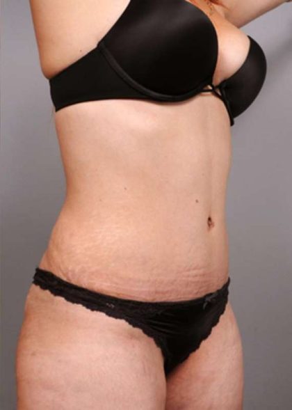 Tummy Tuck Before & After Patient #370