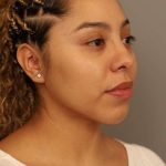 Chin Implant Before & After Patient #2210