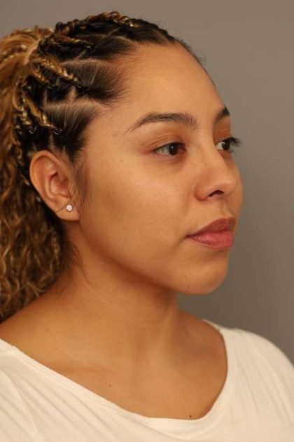 Chin Implant Before & After Patient #2210