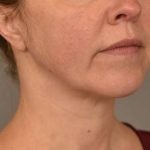 Chin Implant Before & After Patient #2220