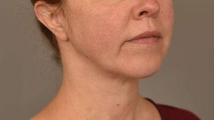 Chin Implant Before & After Patient #2220