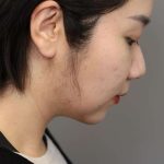 Chin Implant Before & After Patient #2234