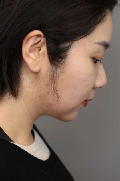 Chin Implant Before & After Patient #2234