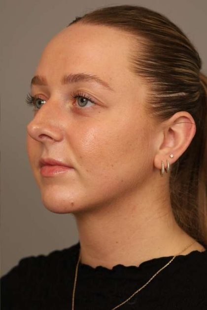 Chin Implant Before & After Patient #2262