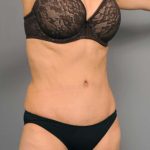 Tummy Tuck Before & After Patient #377