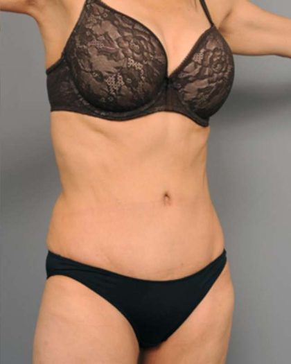 Tummy Tuck Before & After Patient #377
