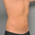 Liposuction For Men Before & After Patient #2294