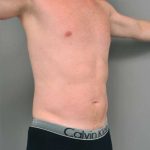 Liposuction For Men Before & After Patient #2301