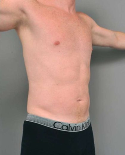 Liposuction For Men Before & After Patient #2301