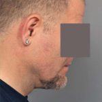 Liposuction For Men Before & After Patient #2308