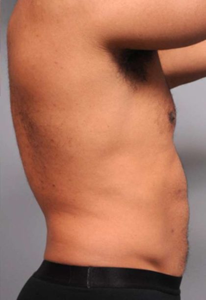 Liposuction For Men Before & After Patient #2315