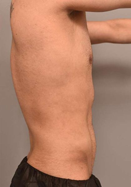 Liposuction For Men Before & After Patient #2358