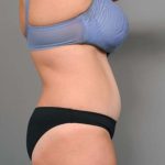 Tummy Tuck Before & After Patient #386