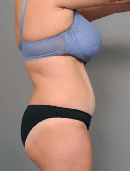 Tummy Tuck Before & After Patient #386