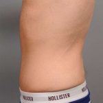 Tummy Tuck For Men Before & After Patient #2394