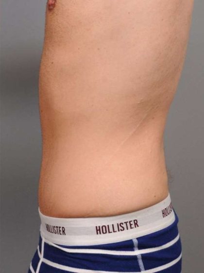 Tummy Tuck For Men Before & After Patient #2394