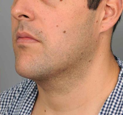 Neck Liposuction For Men Before & After Patient #2408