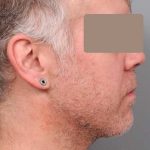 Neck Liposuction For Men Before & After Patient #2426