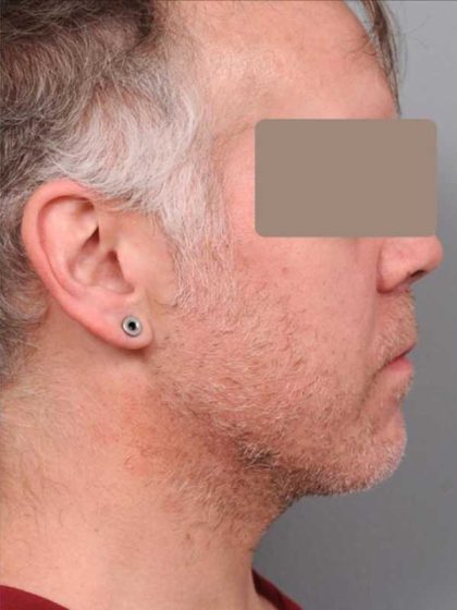 Neck Liposuction For Men Before & After Patient #2426