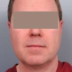 Neck Liposuction For Men Before & After Patient #2433