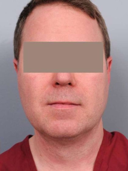 Neck Liposuction For Men Before & After Patient #2433
