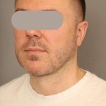 Neck Lift For Men Before & After Patient #2463