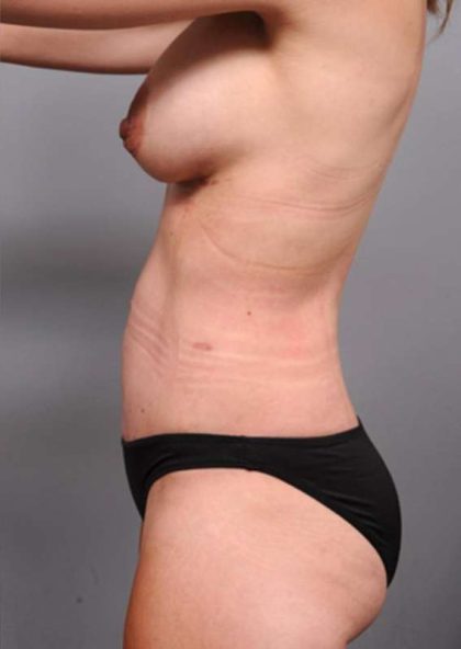 Mommy Makeover Before & After Patient #2520