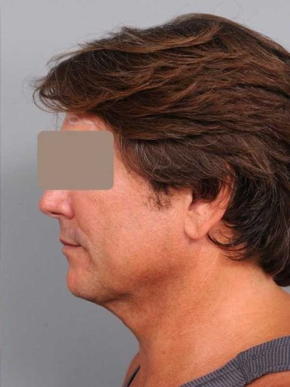 IPL Photofacial Before & After Patient #2559