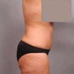 Tummy Tuck Before & After Patient #402