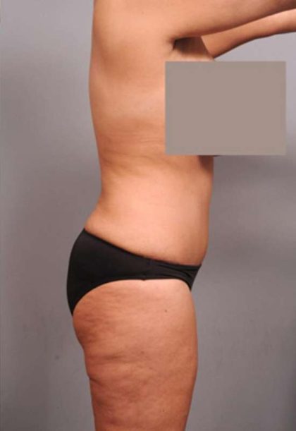 Tummy Tuck Before & After Patient #402
