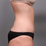 Tummy Tuck Before & After Patient #411