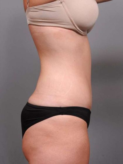 Tummy Tuck Before & After Patient #411