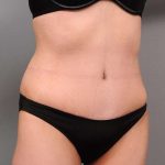 Tummy Tuck Before & After Patient #418