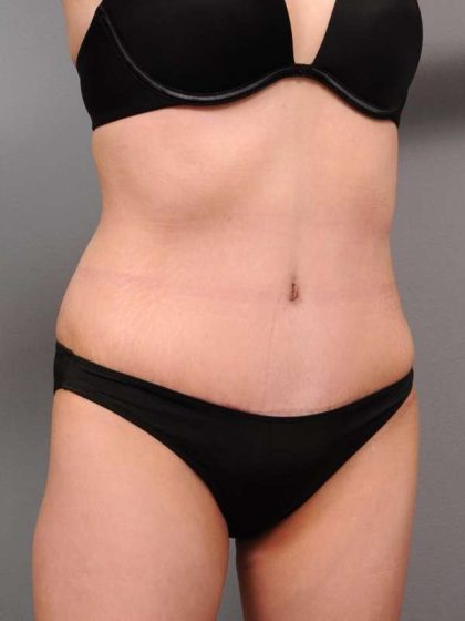Tummy Tuck Before & After Patient #418