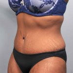 Tummy Tuck Before & After Patient #427