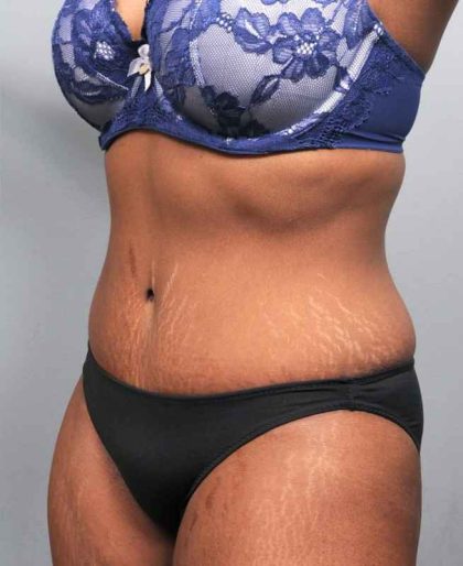 Tummy Tuck Before & After Patient #427